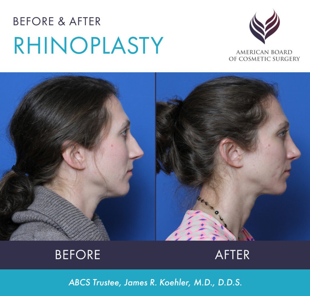 Before and after rhinoplasty surgery with ABCS Trustee James R. Koehler, M.D., D.D.S.