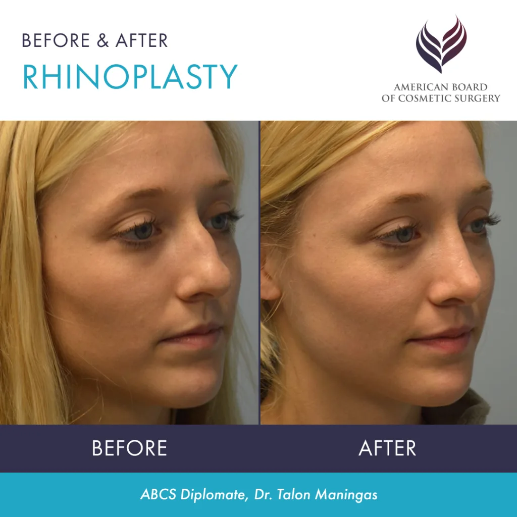Before and after rhinoplasty surgery by ABCS Diplomate Dr. Talon Maningas