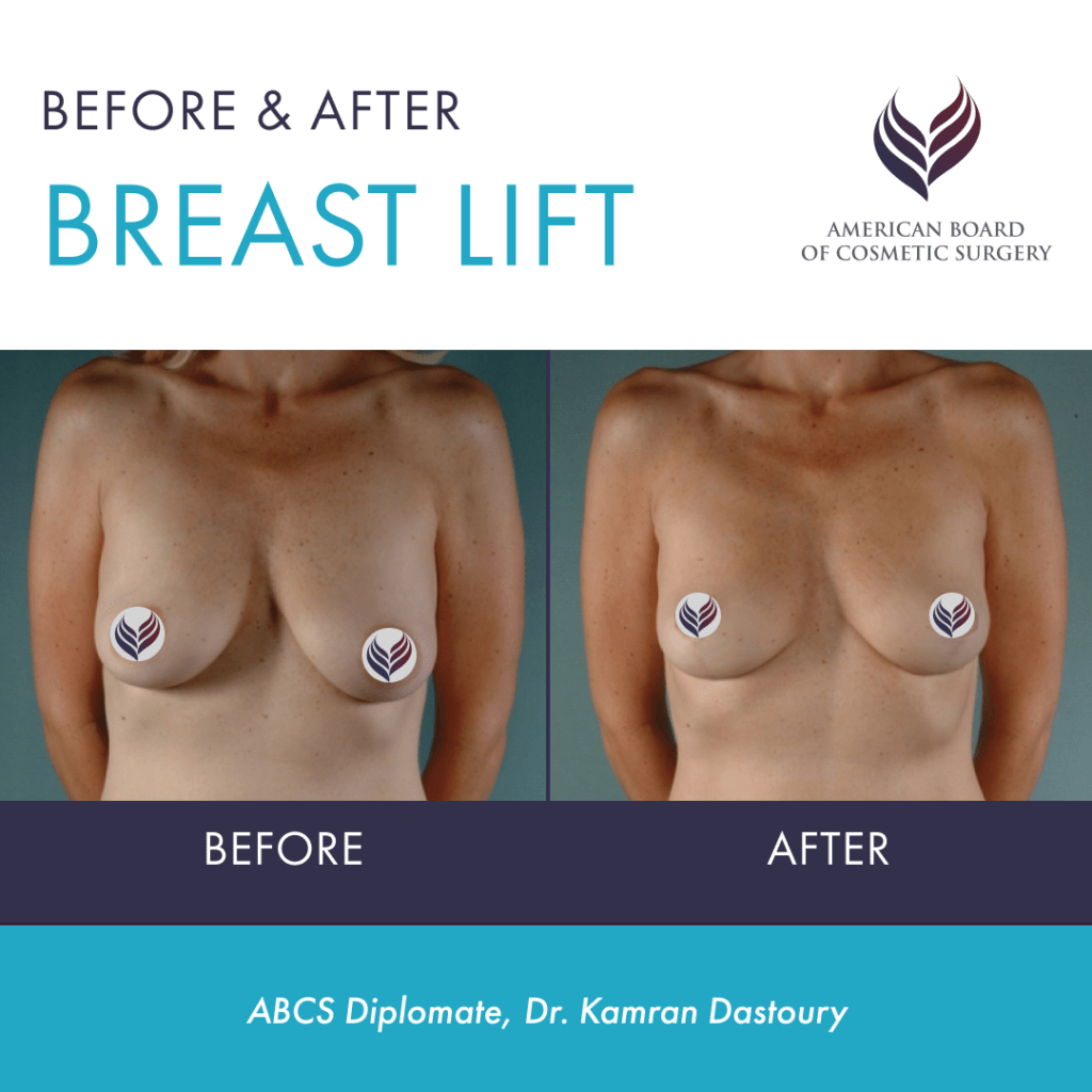 Before and after breast lift with ABCS Diplomate Dr. Kamran Dastoury
