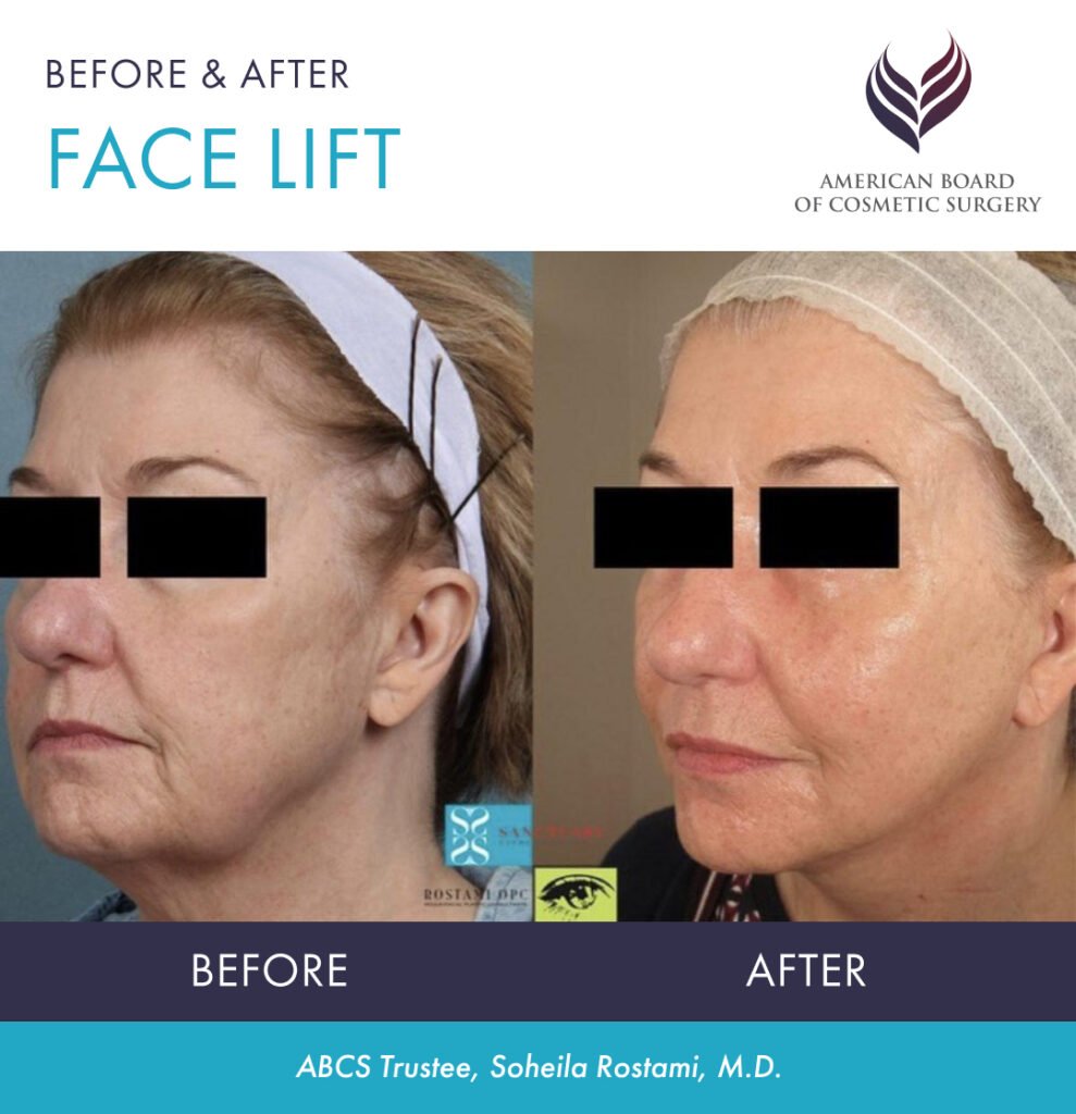 Before and after facelift by ABCS diplomate Soheila Rostrami, MD