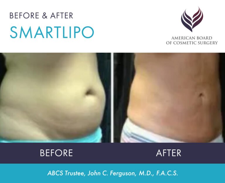 Before and after SmartLipo by ABCS Trustee Dr. John C. Ferguson