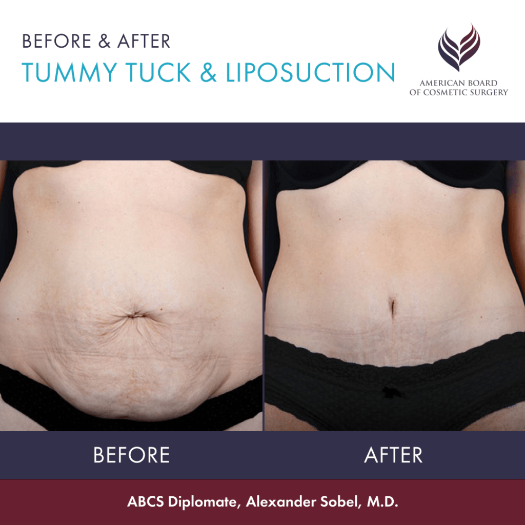 Before and after tummy tuck with ABCS Diplomate Dr. Alexander Sobel