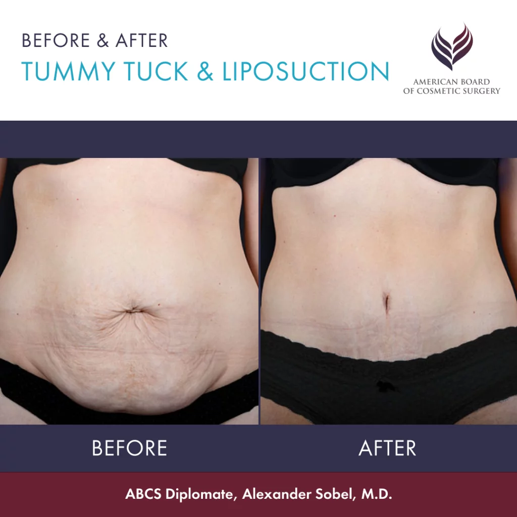 Tummy Tuck, Abdominoplasty Guide