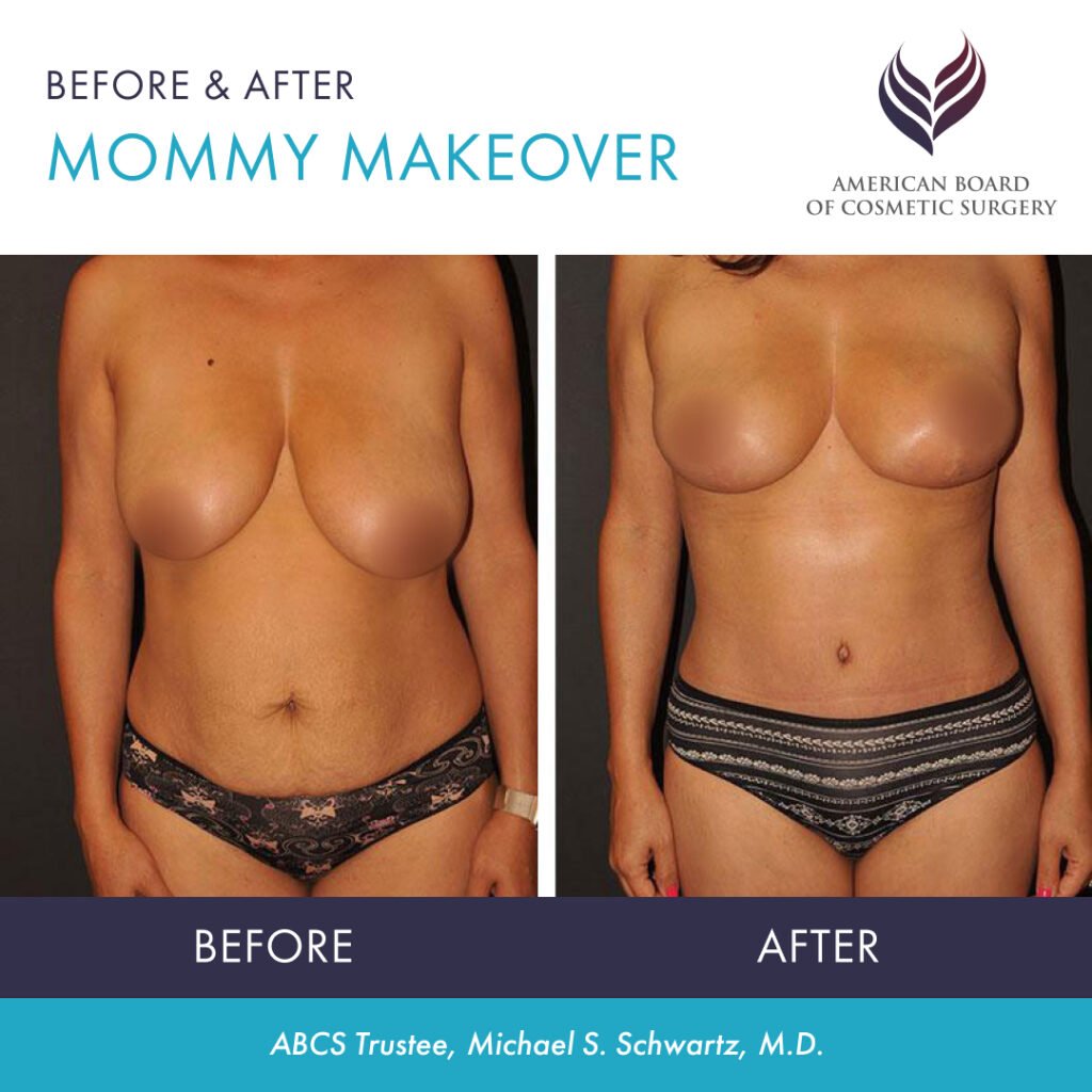 Before and after mommy makeover surgery with ABCS Trustee Dr. Michael S. Schwartz