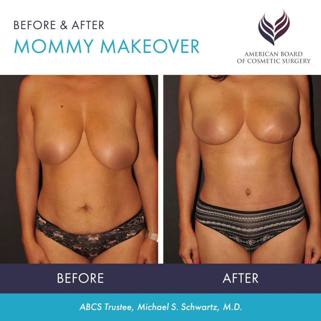 Mommy Makeover Austin Tx