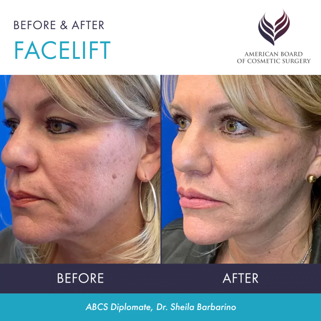 Before and after facelift by ABCS diplomate Dr. Sheila Barbarino