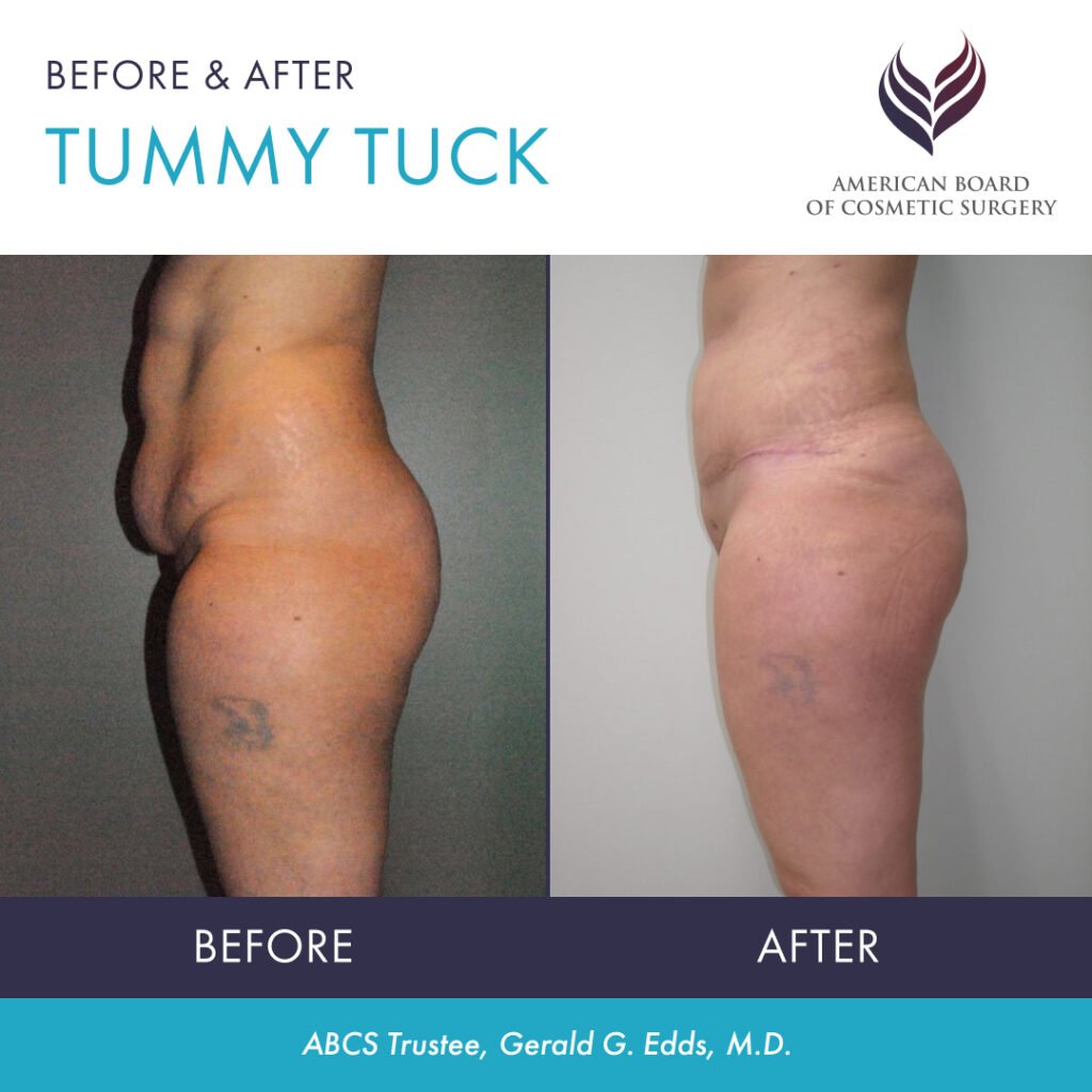 Before and after tummy tuck with ABCS Trustee Dr. Gerald E. Edds