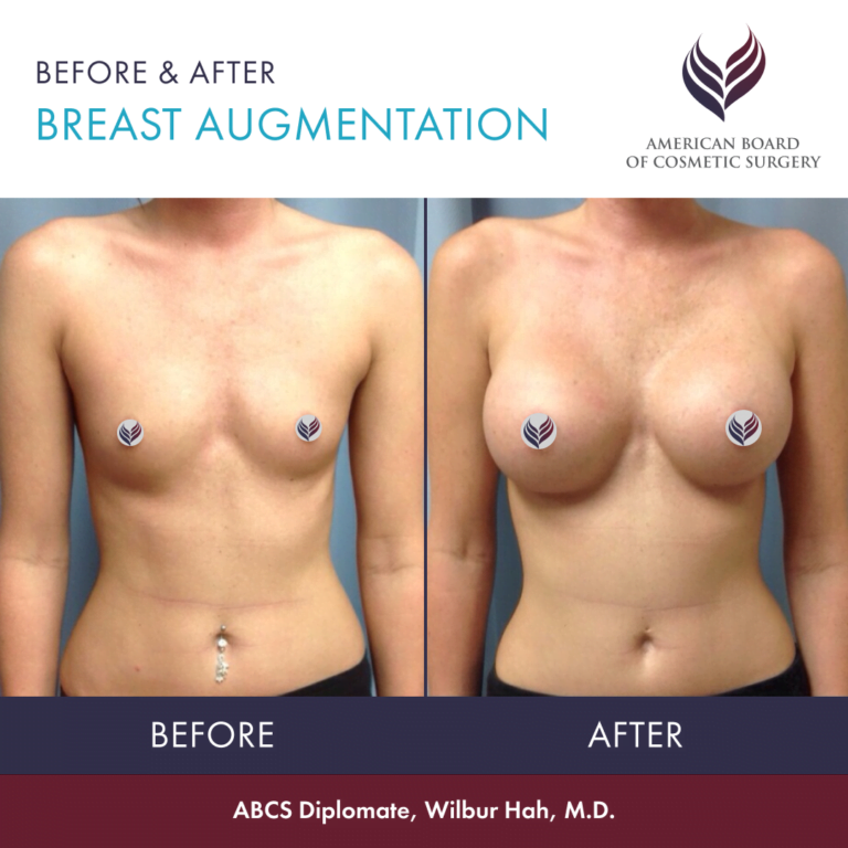 Before and after breast augmentation with ABCS Diplomate Dr. Wilbur Hah