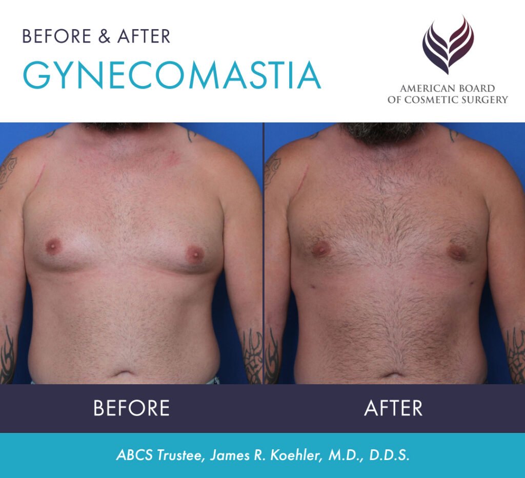 Before and after male breast reduction