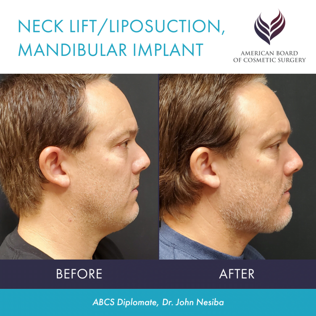 Before and After Manibular Implant by ABCS Diplomate Dr. John Nesiba