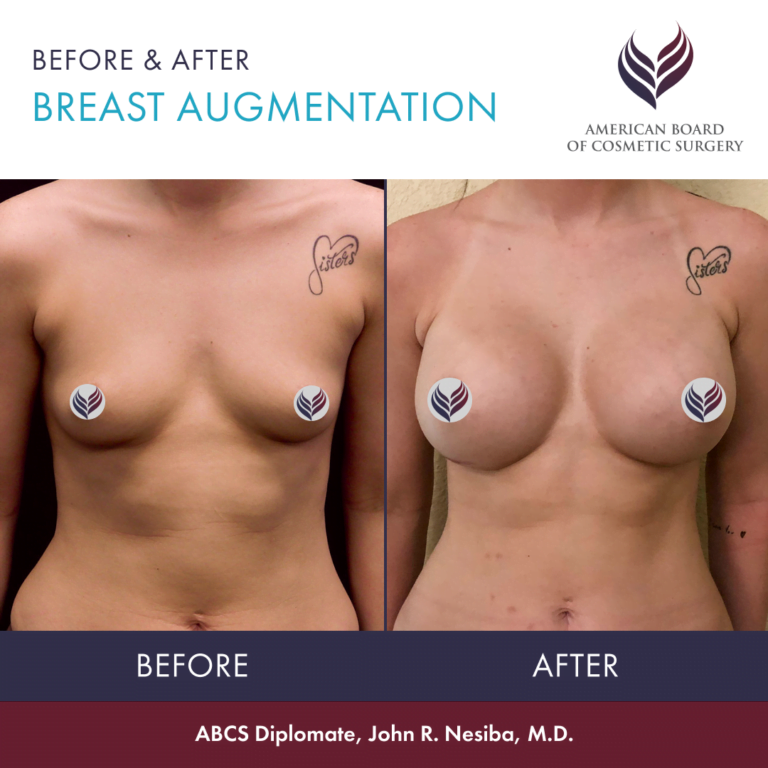 Before and after breast augmentation with ABCS Diplomate Dr. John R. Nesiba