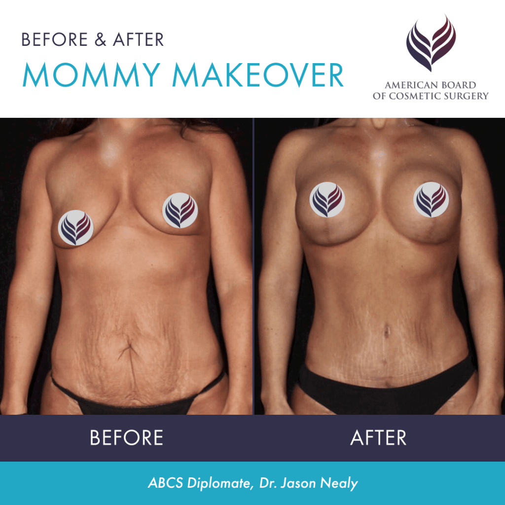 Before and after mommy makeover surgery with ABCS Diplomate Dr. Jason Nealy
