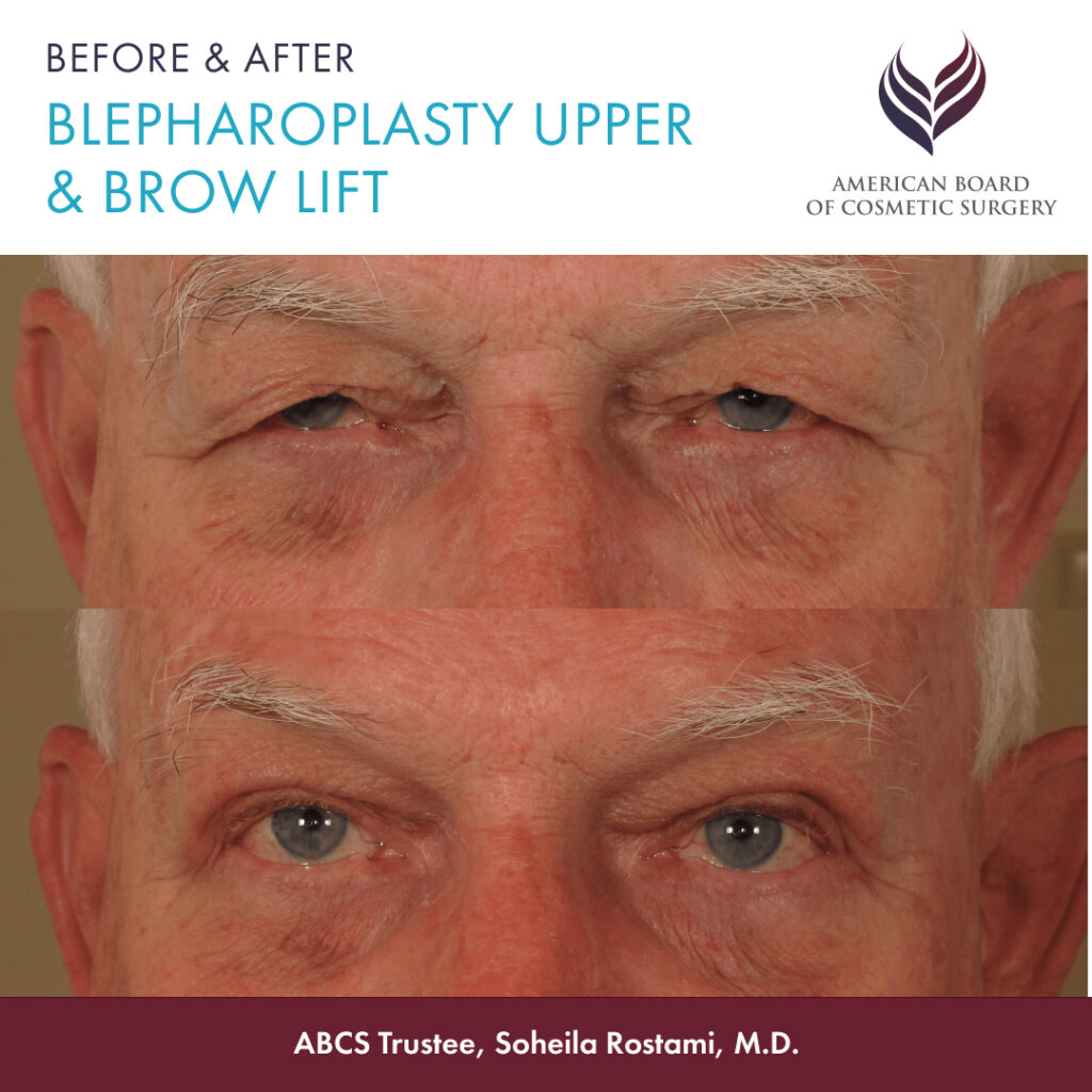 Before and after brow lift and upper eyelid surgery by ABCS Trustee Soheila Rostrami, M.D.