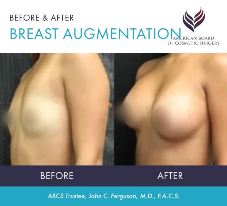 Before and after breast augmentation with ABCS Trustee Dr. John C. Ferguson