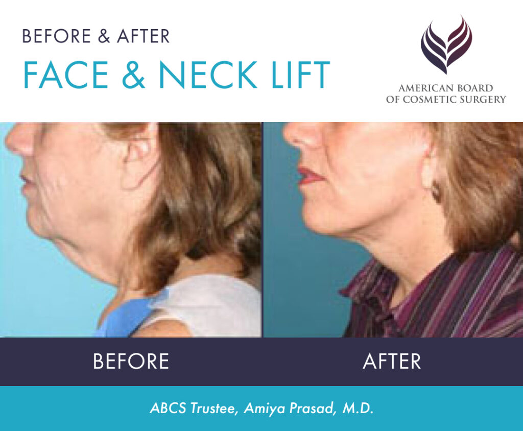 Before and after face and neck lift by ABCS Trustee Amiya Prasad, M.D.