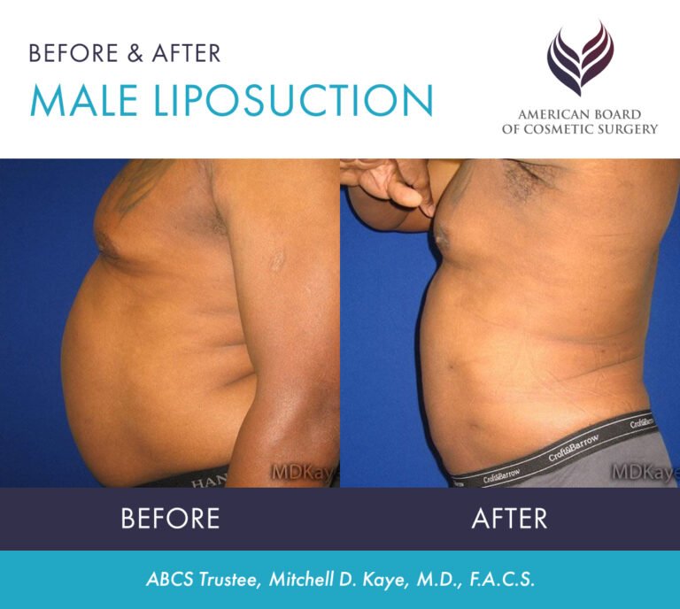 Male patient shown before and after liposuction by ABCS Trustee Dr. Mitchell D. Kaye