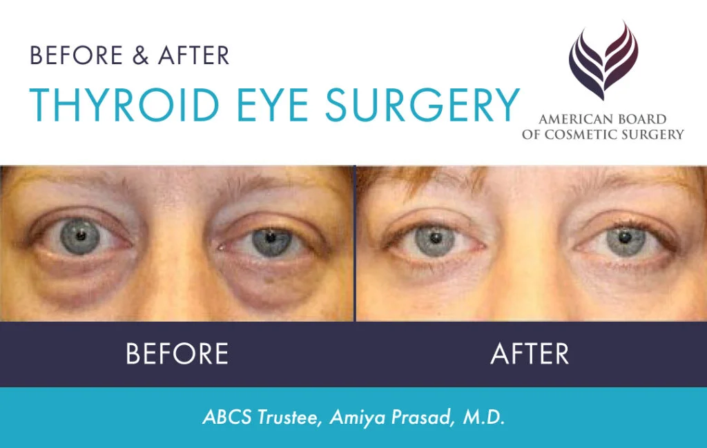 Before and after eyelid surgery by ABCS trustee Amiya Prasad, MD