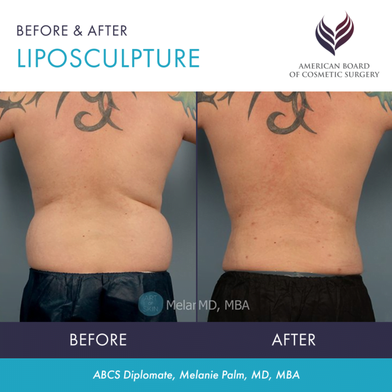 Before and after liposculpture body contouring by ABCS Diplomate Dr. Melanie Palm