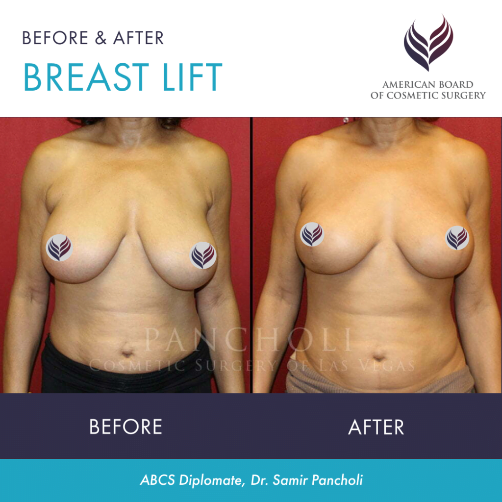 Before and after breast lift with ABCS Diplomate Dr. Samir Pancholi