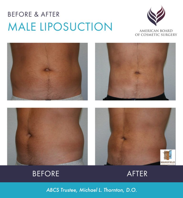 Male patient shown before and after liposuction by ABCS Trustee Dr. Michael L. Thornton