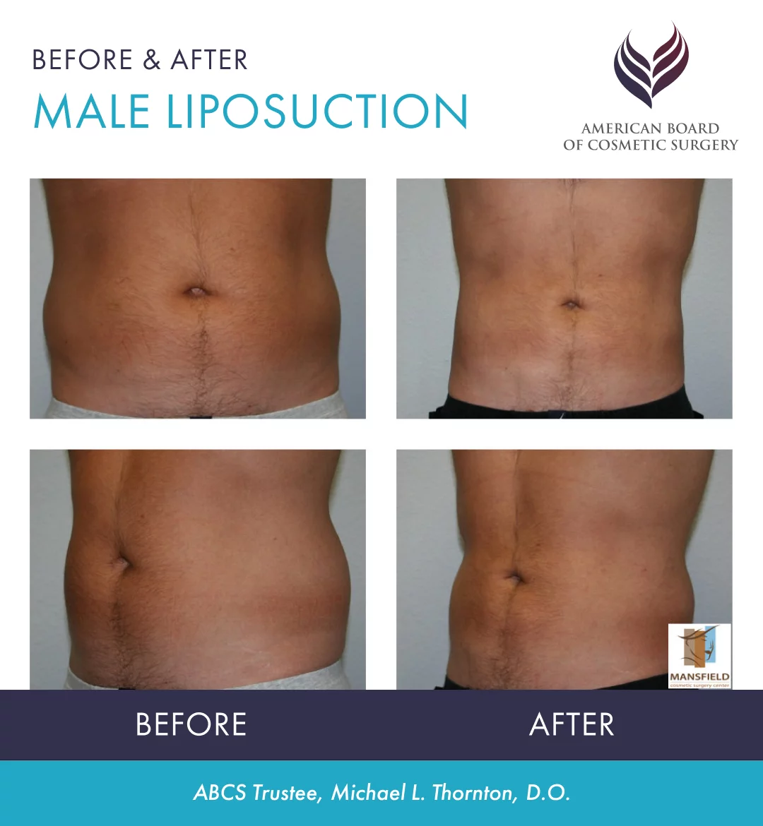 Liposuction | Patient Guide - The American Board of Cosmetic Surgery