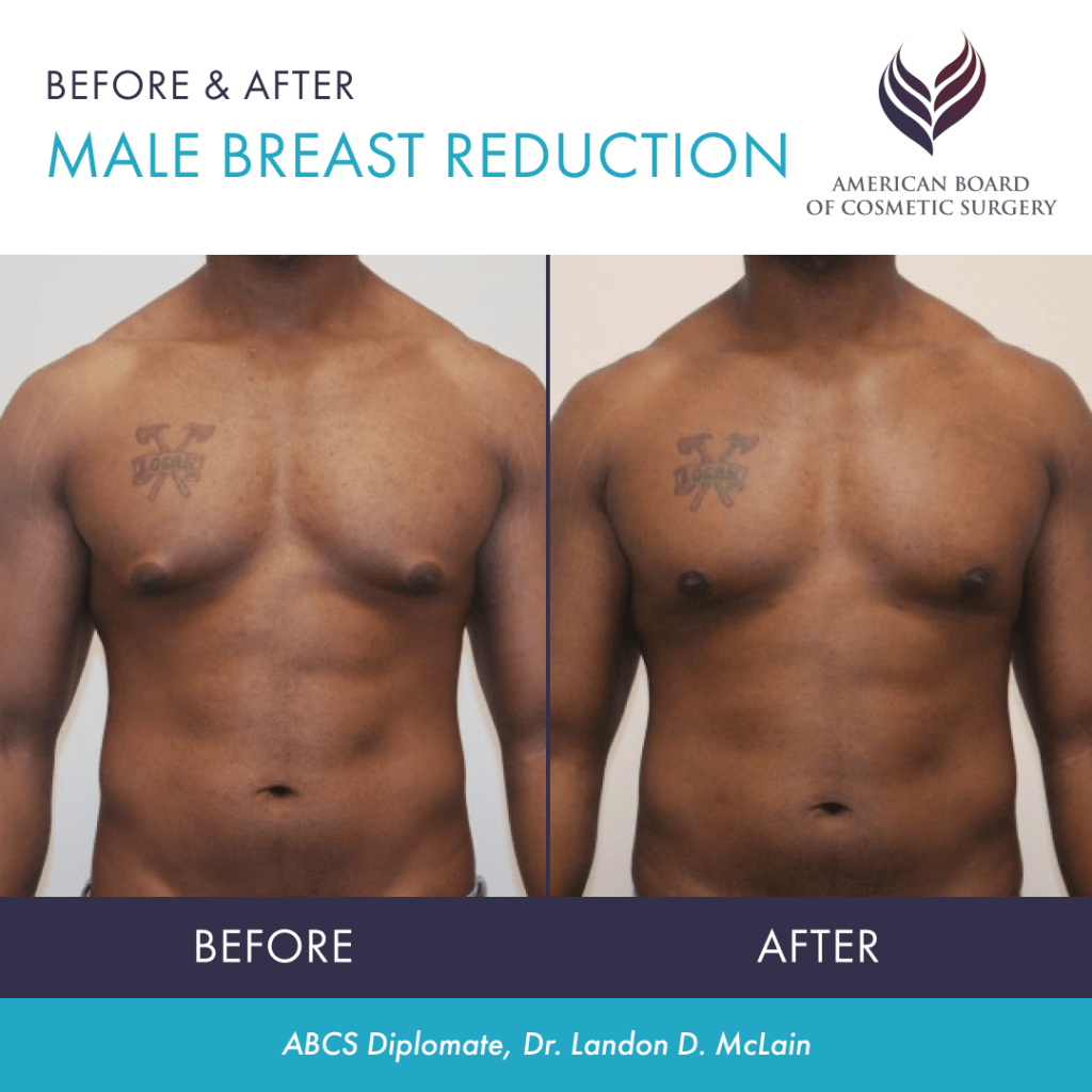 Before and after male breast reduction