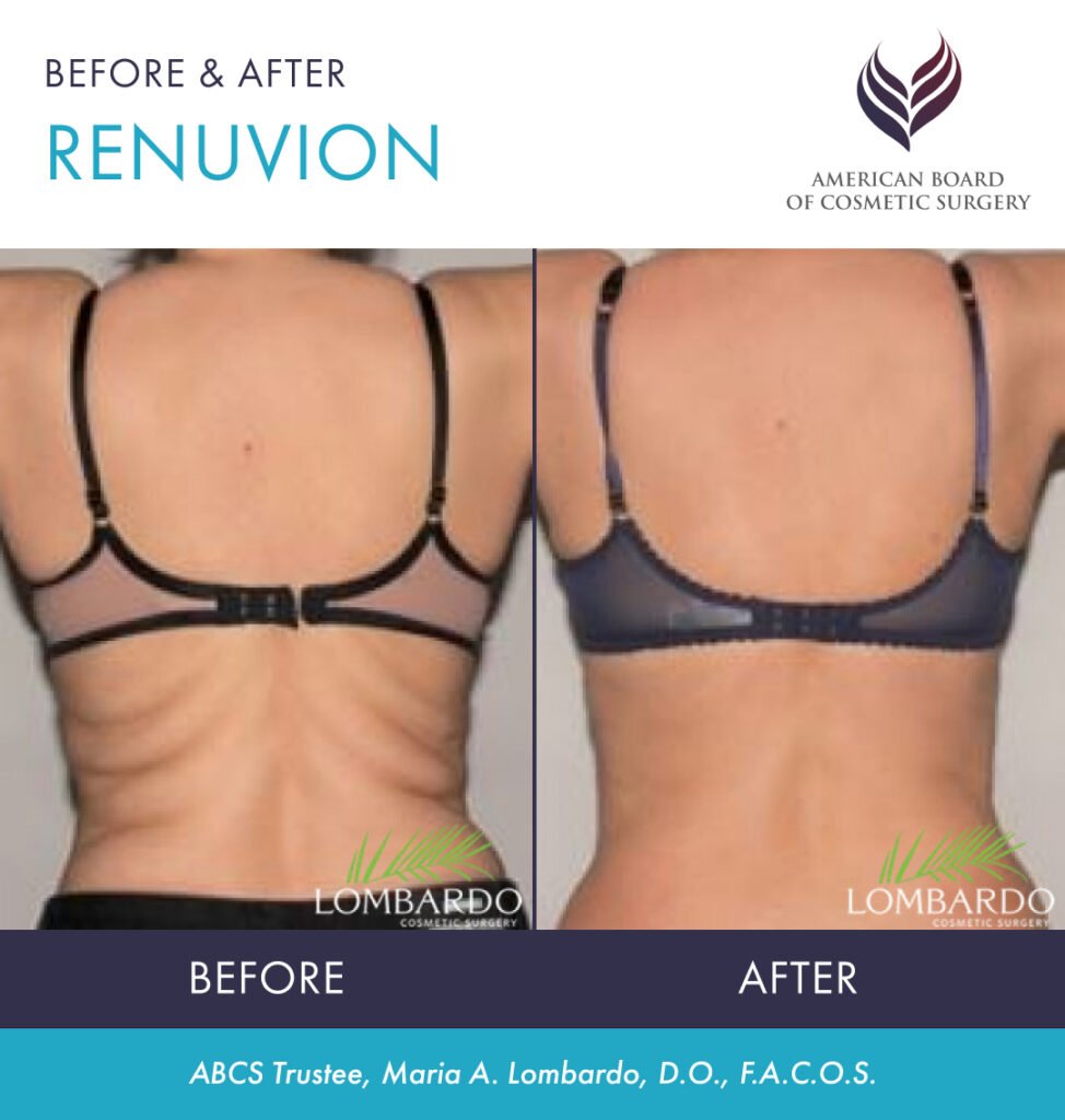 Before and after non-surgical skin tightening Renuvion
