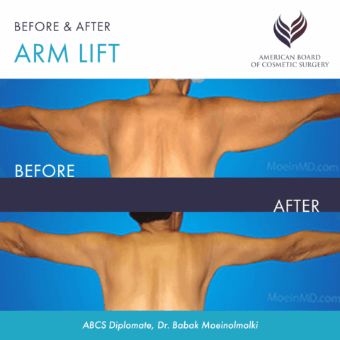 Before and after arm lift surgery