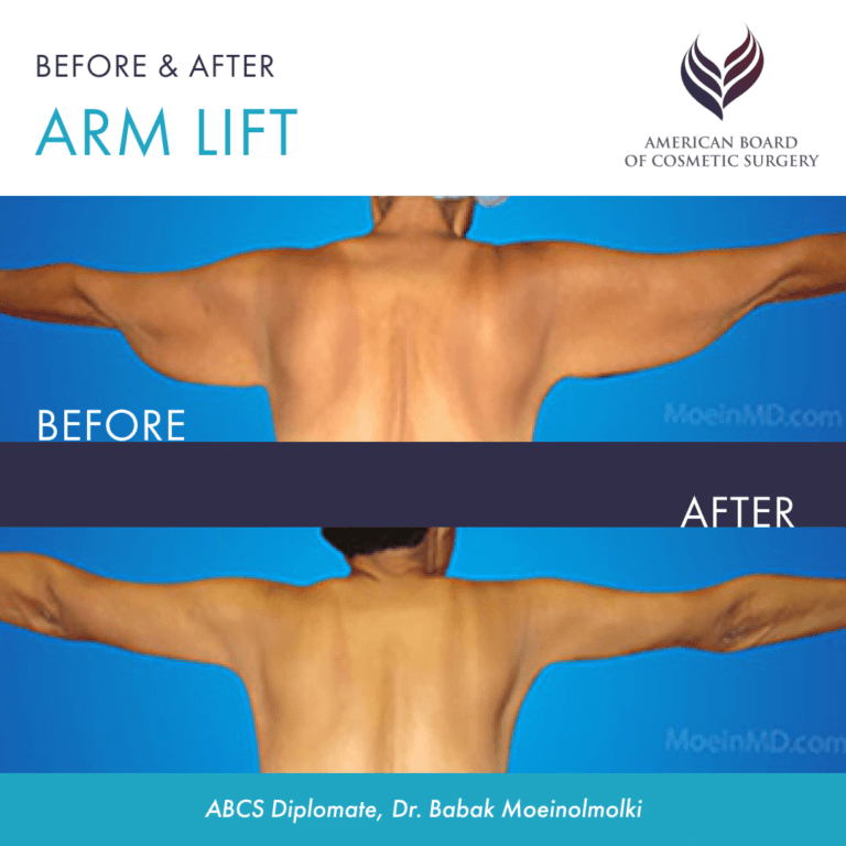 Before and after arm lift surgery