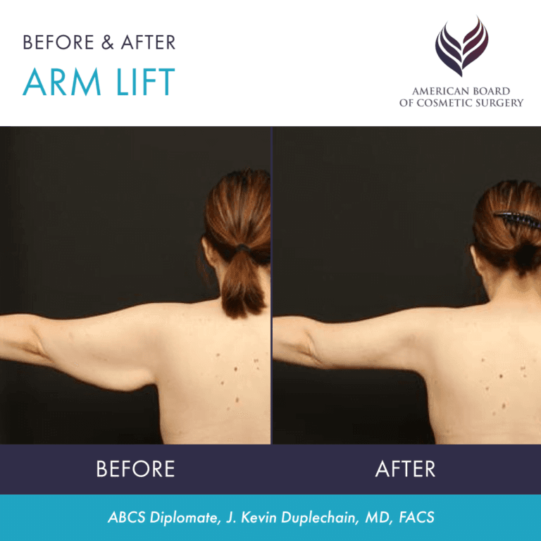 Before and after arm lift surgery