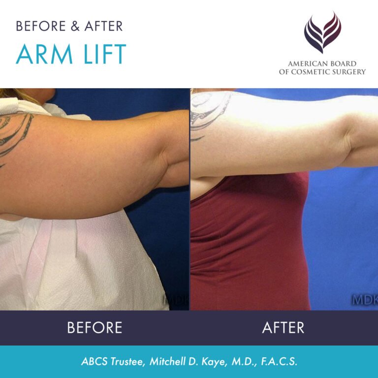 Before and after arm lift surgery