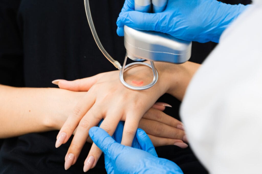 CO2 resurfacing laser for hand rejuvenation