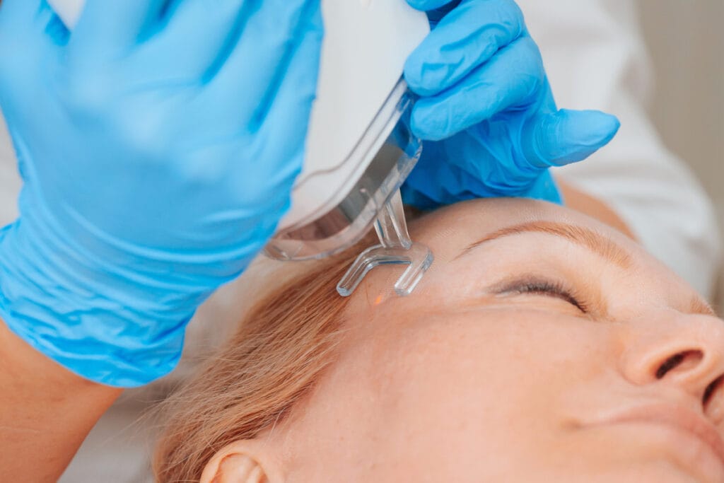 Woman getting a CO2 laser skin resurfacing treatment