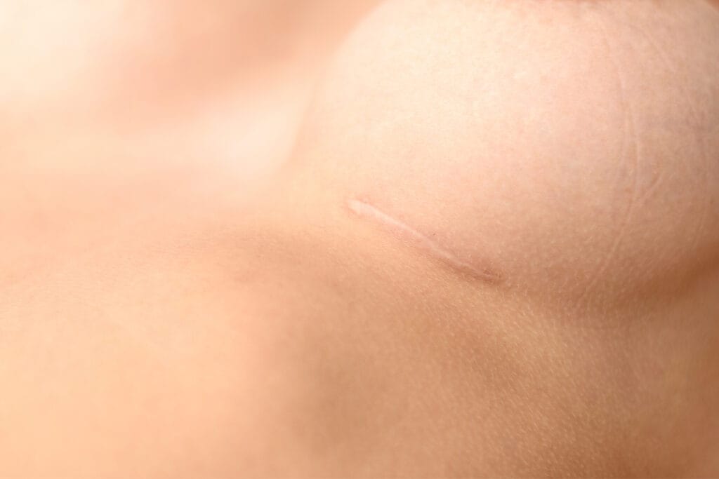 Closeup of healed breast surgery scar