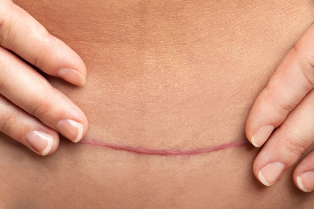 Closeup of post-surgical scar on woman's lower belly